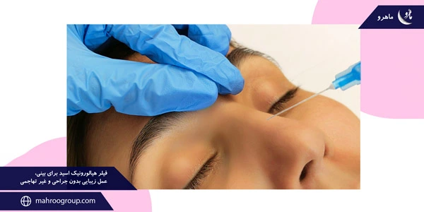 Hyaluronic-acid-filler-for-the-nose,-a-non-surgical-and-non-invasive-cosmetic-procedure