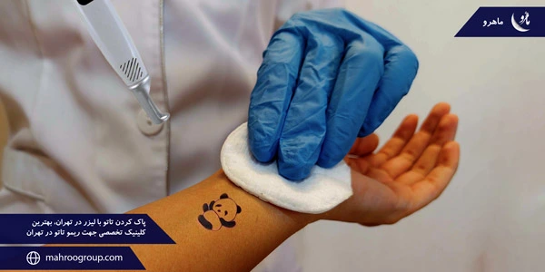 Laser-tattoo-removal-in-Tehran,-the-best-specialized-clinic-for-tattoo-removal-in-Tehran