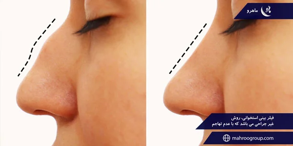 Bone-nose-filler-is-a-non-surgical-method-that-is-non-invasive