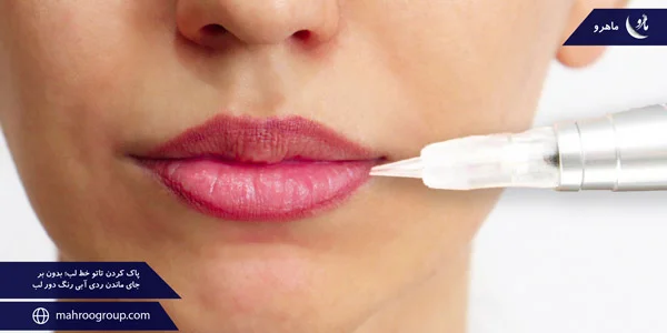 removing-the-lip-line-tattoo-Without-leaving-a-blue-trace-around-the-lips