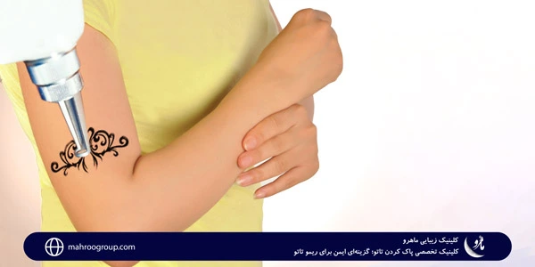Specialized-tattoo-removal-clinic;-A-safe-option-for-rimo-tattoo