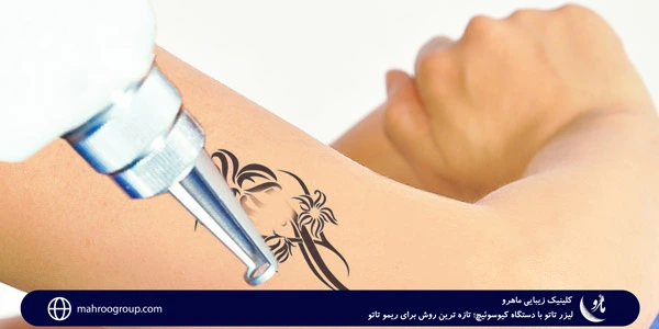 tattoo-laser-with-Kioswitch-device;-The-latest-method-for-rimo-tattoo