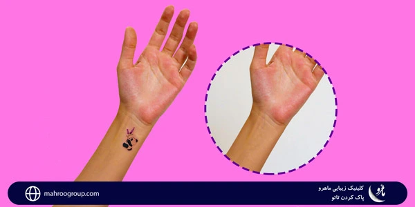 Tattoo-removal