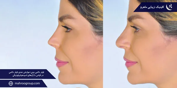 permanent-nose-filler-Serious-side-effects-of-permanent-filler-compared-to-hyaluronic-acid-gels