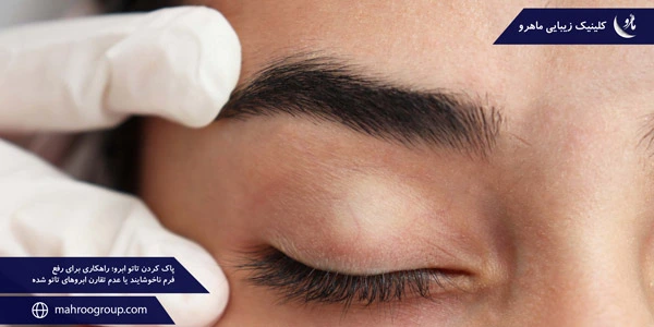 remove-eyebrow-tattoo-A-solution-to-fix-the-unpleasant-form-or-asymmetry-of-tattooed-eyebrows