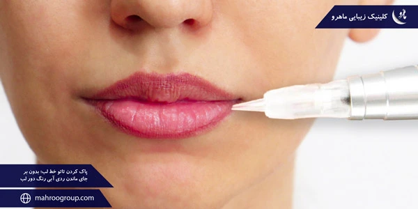 removing-the-lip-line-tattoo-Without-leaving-a-blue-trace-around-the-lips