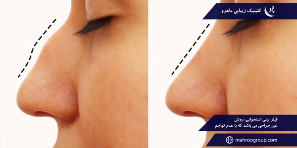 Bone-nose-filler-is-a-non-surgical-method-that-is-non-invasive