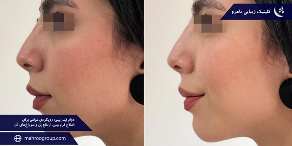 Durability-of-nasal-filler-A-temporary-approach-to-correct-the-shape-of-the-nose-the-height-of-the-bridge-and-its-holes