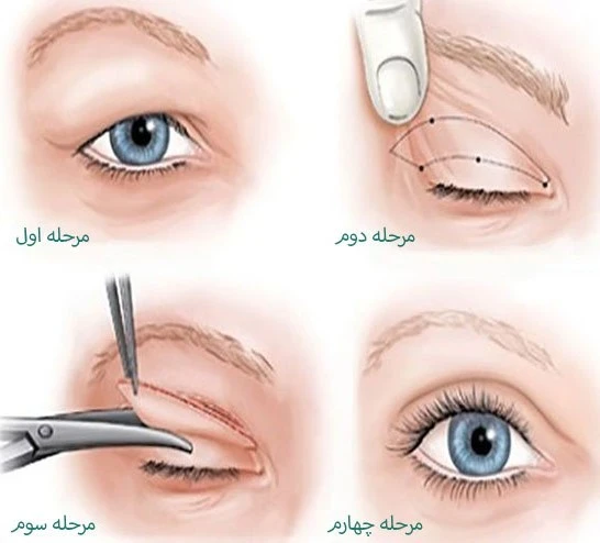 Eyelid-surgery-recovery-period
