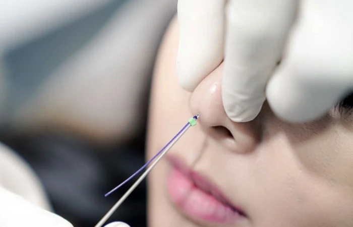 Is-nose-filler-permanent