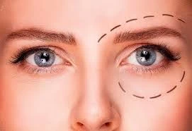 Laser-eyelid-surgery
