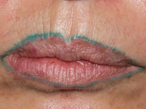 Lip-line-tattoo-removal