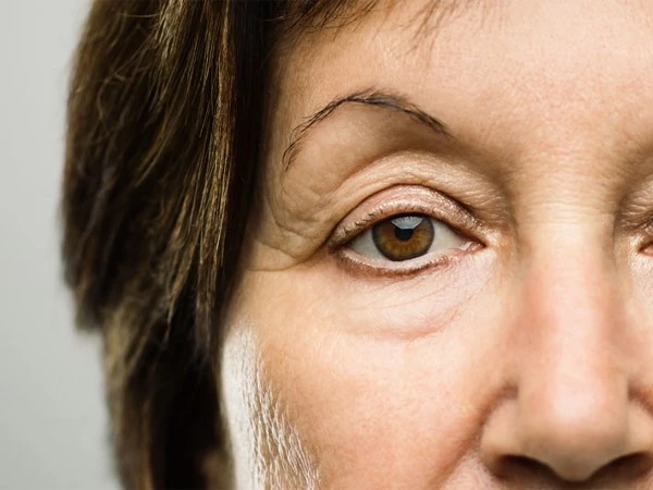 Treatment-drooping-eyelid-surgery