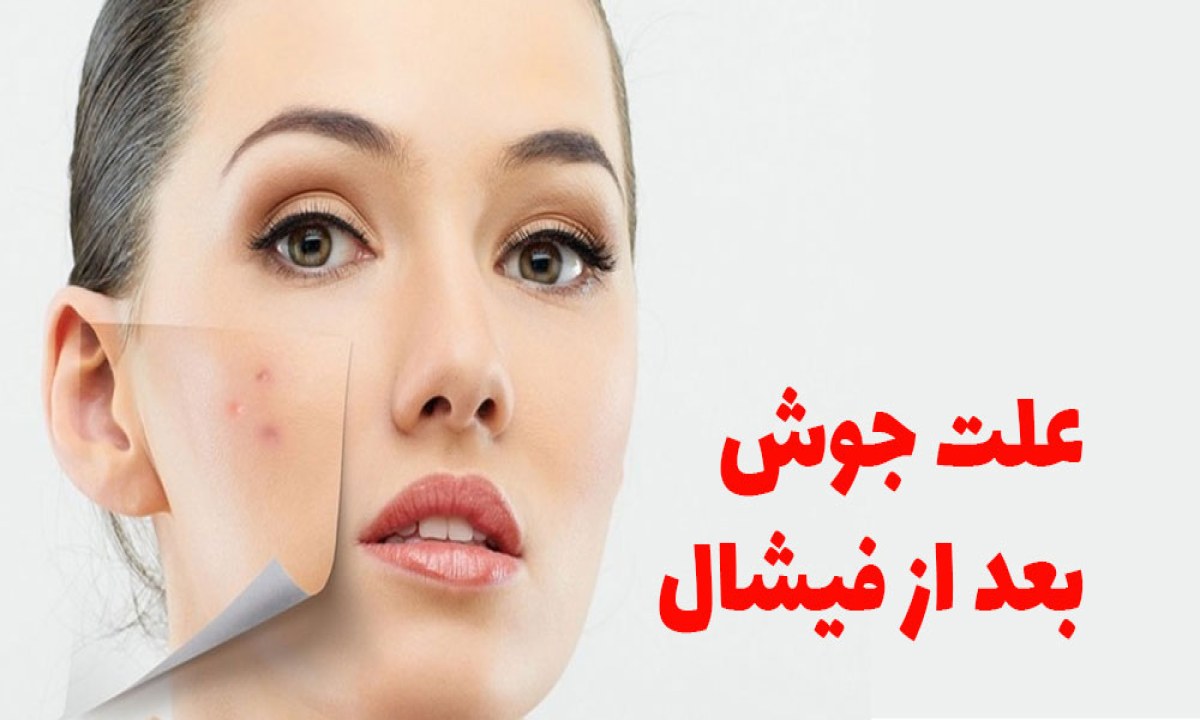 علت جوش زدن صورت بعد از فیشیال