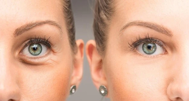 difference-canthoplasty-blepharoplasty